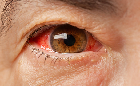 close up of an eye showing glaucoma symptoms