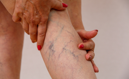 Woman examining legs for varicose vein treatment
